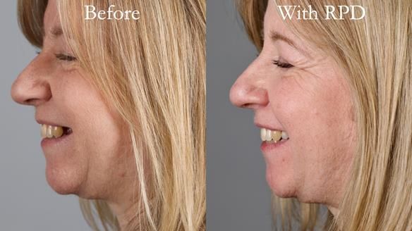 Solving Sue's failed implants with metal based RPD - full protocol Newsletter 43