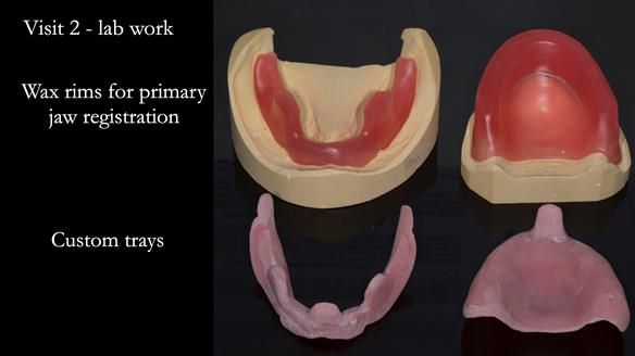Newsletter 75: Marion’s case - Step-by-step complete denture workflow