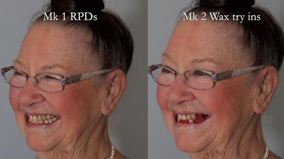 Finlay's Case Study Newsletter 40 - Immediate Mk 1 RPD to Definitive Mk 2 RPD - full protocol