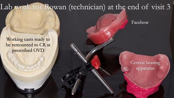Newsletter 52 Managing Jo’s failing dentition with extractions and Mk 1/Mk 2 complete upper dentures and lower partial dentures FULL PROTOCOL