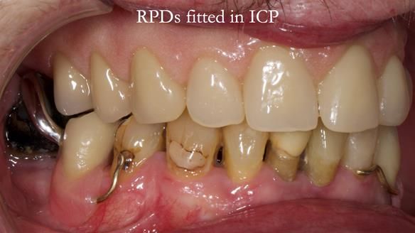 Newsletter 55 Provision of metal based partial dentures for Zephyrine with a repaired cleft lip and palate