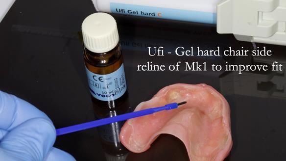 Newsletter 78: What do Clark Gable and a Locator® overdenture have in common?