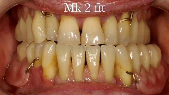 Finlay's Case Study Newsletter 40 - Immediate Mk 1 RPD to Definitive Mk 2 RPD - full protocol