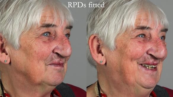 Newsletter 55 Provision of metal based partial dentures for Zephyrine with a repaired cleft lip and palate