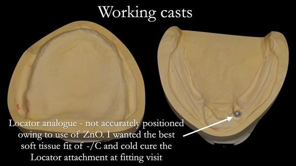Managing poor implant positioning with complete dentures and Locator attachments - full protocol Newsletter 41