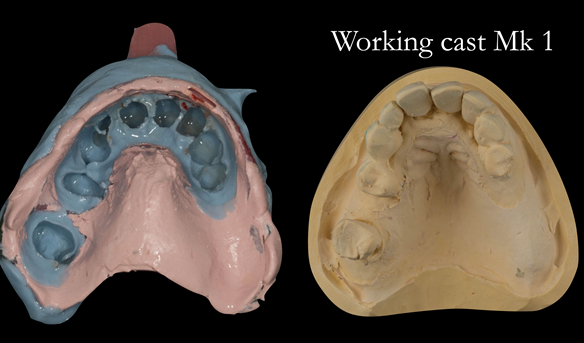 Figure 20 Left completed 2 part impression - right working cast for Mk 1 denture
