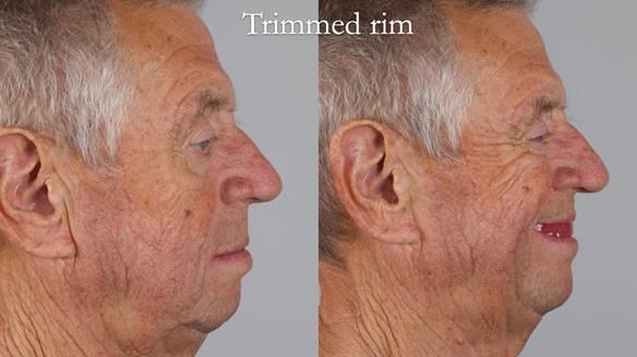 Newsletter 54 case presentation upper complete denture and lower Scandinavian designed hygienic partial denture for David