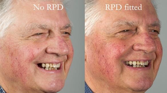 Finlay's Newsletter 64 case study - provision of a Kennedy class 2 metal based Scandinavian RPD for Ian