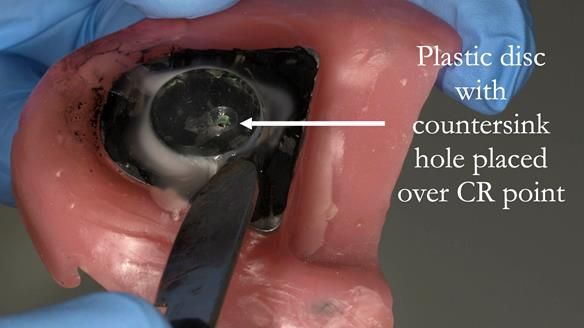 Plastic disc with hole is fitted with melted wax onto the plate directly over the triangle point