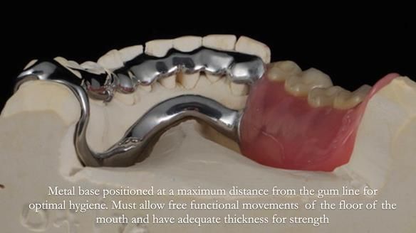 Finlay's Newsletter 61 provision of a lower unilateral free end saddle metal based partial denture for Joyce