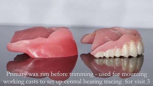 Newsletter 54 case presentation upper complete denture and lower Scandinavian designed hygienic partial denture for David