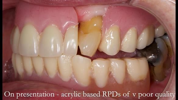 Finlay's Newsletter 59 Ultra hard partial dentures made for Gill