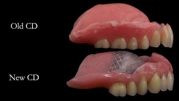 Finlay's Newsletter 62 provision of extractions and metal based complete dentures for Rafique