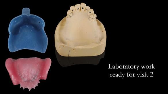 Newsletter 56 showing the making and fitting of a bilateral free end saddle upper removable partial denture (RPD) for patient with pemphigus