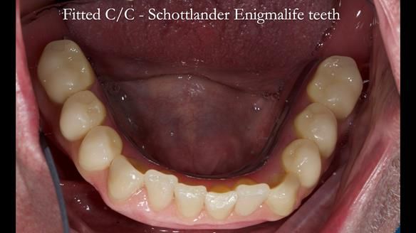 Complete denture Class II div 2 deep overbite Newsletter 39