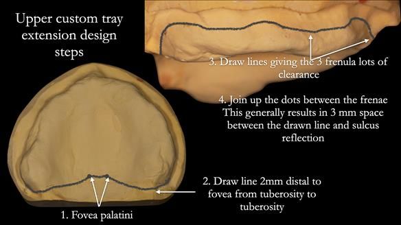 Newsletter 52 Managing Jo’s failing dentition with extractions and Mk 1/Mk 2 complete upper dentures and lower partial dentures FULL PROTOCOL