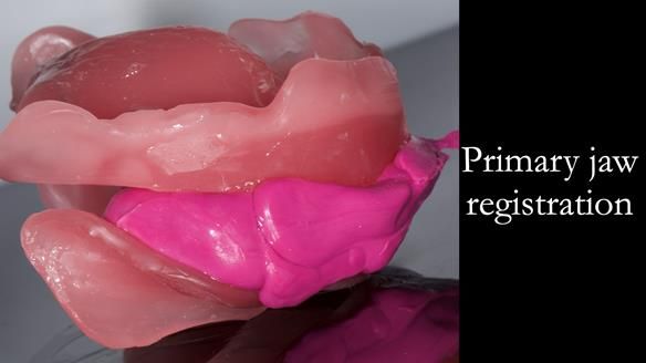 Complete denture Class II div 2 deep overbite Newsletter 39