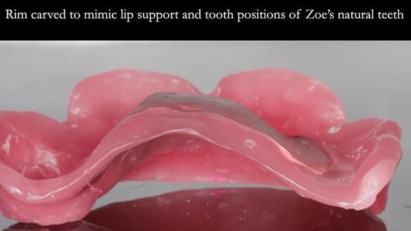 Finlay's Newsletter 58 Gasket upper partial denture for Zoe