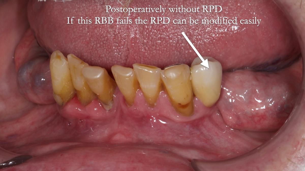 Newsletter 87 – Father Peter: A Partial Denture that needed Minor Miracle