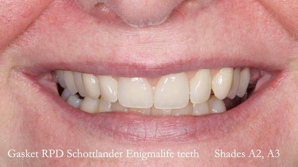 Finlay's Newsletter 58 Gasket upper partial denture for Zoe