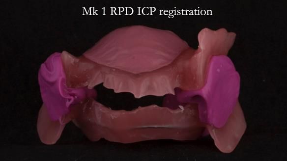 Finlay's Case Study Newsletter 40 - Immediate Mk 1 RPD to Definitive Mk 2 RPD - full protocol