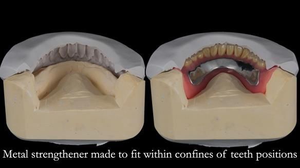 Finlay's Newsletter 62 provision of extractions and metal based complete dentures for Rafique