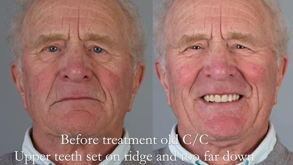 Complete denture Class II div 2 deep overbite Newsletter 39