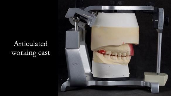 Upper metal base partial denture/occlusal stabilisation splint/obturator - full protocol