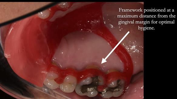 Finlay's Newsletter 63 Case study provision of metal based Scandinavian RPD - functional 10 years on