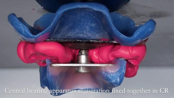 Newsletter 77: Jeremy’s case – immediate complete upper denture