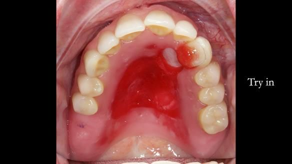 Newsletter 55 Provision of metal based partial dentures for Zephyrine with a repaired cleft lip and palate