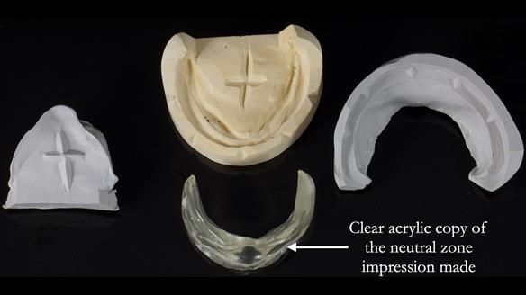 Newsletter 83: Sheila’s Complete Denture Success