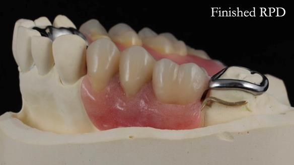 Finlay's Newsletter 60 Sylvia's upper Kennedy Class 2 Mod 1 metal based upper RPD