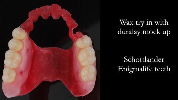 Newsletter 56 showing the making and fitting of a bilateral free end saddle upper removable partial denture (RPD) for patient with pemphigus