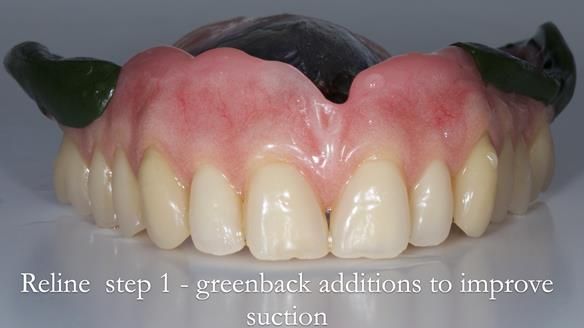 Newsletter 54 case presentation upper complete denture and lower Scandinavian designed hygienic partial denture for David