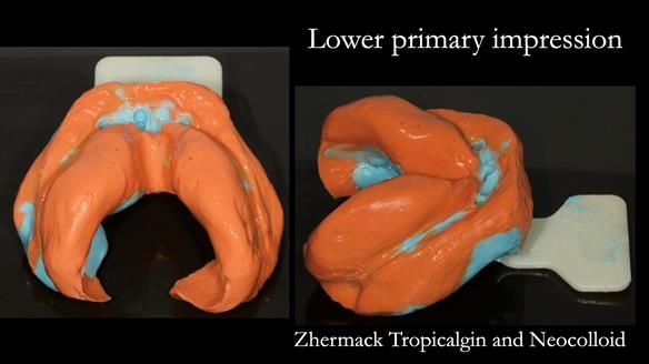 Syringe the light bodied alginate from the retromylohyoid region around the lingual sulcus over the retromolar pad and around the buccal and labial sulcus. A “frame cut back tray” (available from Metrodent) is loaded with heavy bodied alginate.