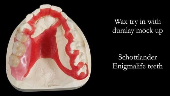 Finlay's Newsletter 64 case study - provision of a Kennedy class 2 metal based Scandinavian RPD for Ian