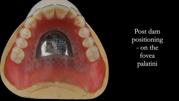 Prior to processing the post dam will be incorporated int the finished denture