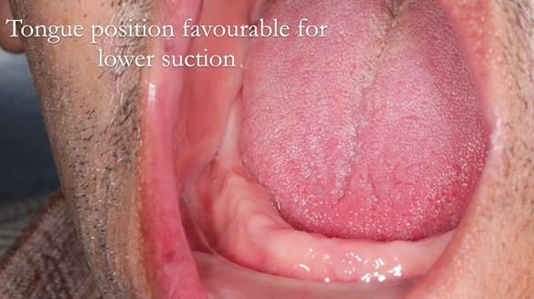 Finlay's Newsletter 62 provision of extractions and metal based complete dentures for Rafique