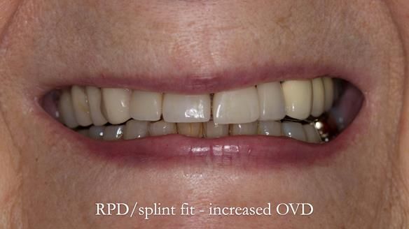 Newsletter 51 Managing Anne’s failing dentition with distal extension base RPD/Splint FULL PROTOCOL