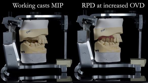Finlay's Newsletter 64 case study - provision of a Kennedy class 2 metal based Scandinavian RPD for Ian