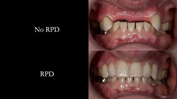 Newsletter 81 - Pam’s Story — how a partial denture changed her life (+ live walkthrough this Thursday)