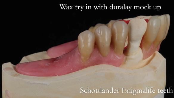 Finlay's Newsletter 59 Ultra hard partial dentures made for Gill