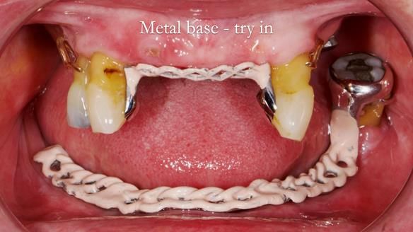 Finlay's Newsletter 59 Ultra hard partial dentures made for Gill