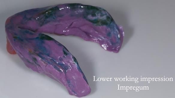 Replacing Madeline’s Complete denture FULL PROTOCOL