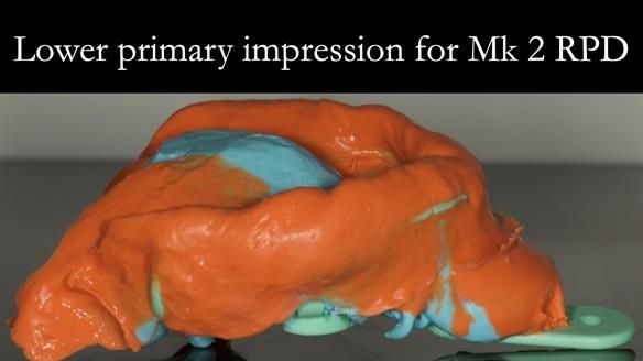 Finlay's Case Study Newsletter 40 - Immediate Mk 1 RPD to Definitive Mk 2 RPD - full protocol