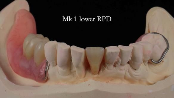 Newsletter 54 case presentation upper complete denture and lower Scandinavian designed hygienic partial denture for David