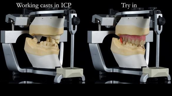 Newsletter 55 Provision of metal based partial dentures for Zephyrine with a repaired cleft lip and palate