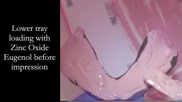 Finlay's Newsletter 62 provision of extractions and metal based complete dentures for Rafique