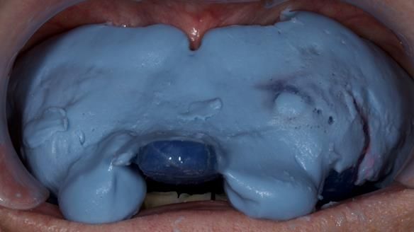 Newsletter 81 - Pam’s Story — how a partial denture changed her life (+ live walkthrough this Thursday)